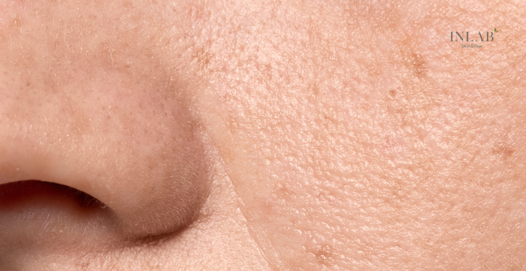Open Pores: Causes, Treatment Options & Prevention Tips