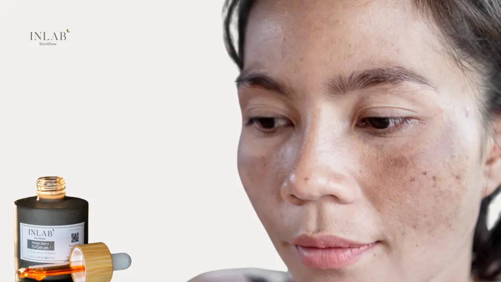 What is Melasma? Causes, Symptoms, & Best Treatments
