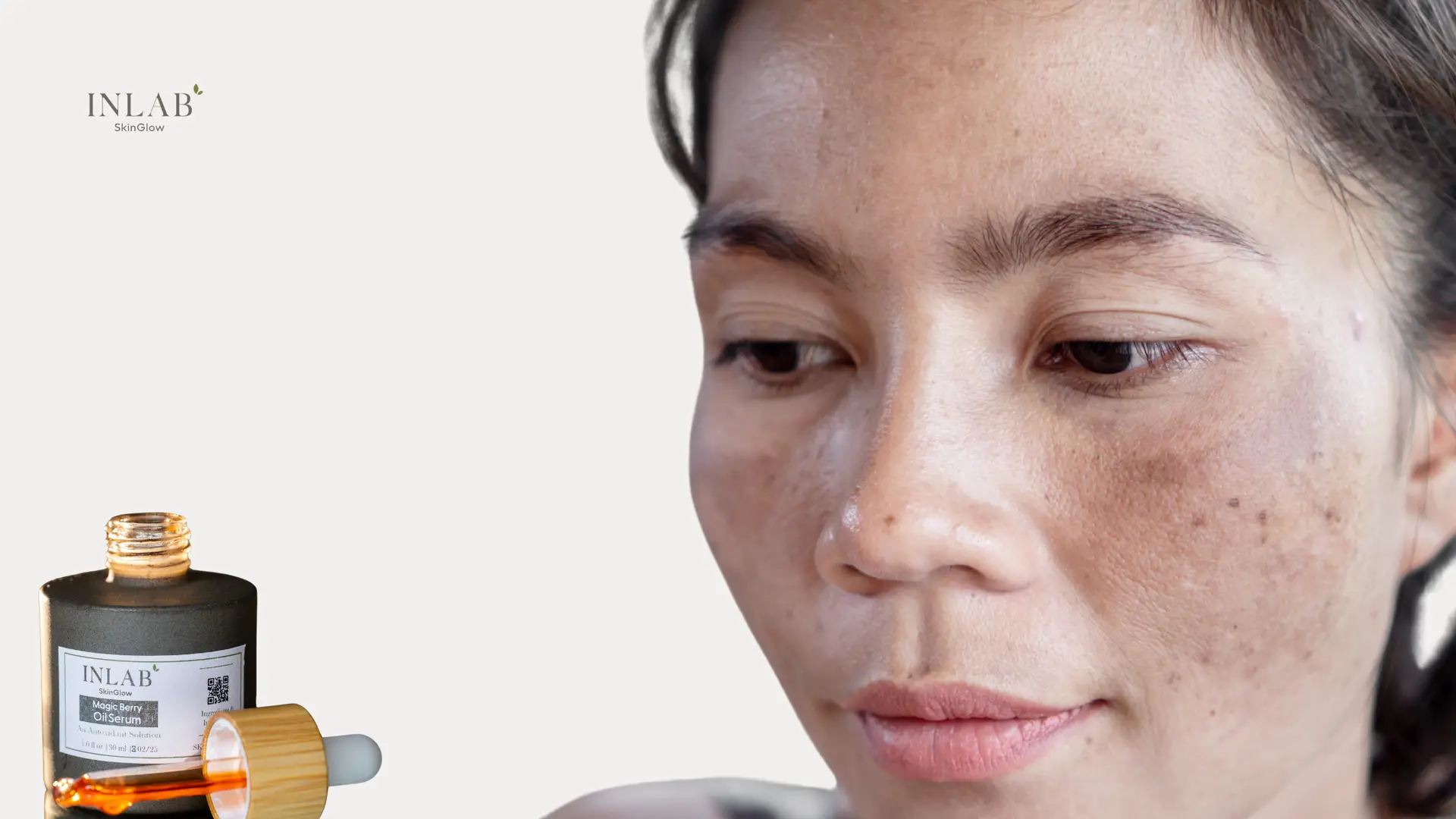 What is Melasma? Causes, Symptoms, & Best Treatments